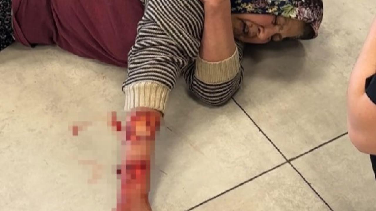 Tekmelere aldırmayan köpek kadının kolunu kopardı